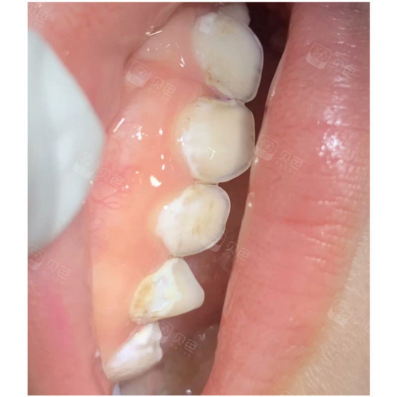 到很多孩子来做口腔检查,妈妈说没有看到黑色的蛀牙,但牙齿缺残缺不全