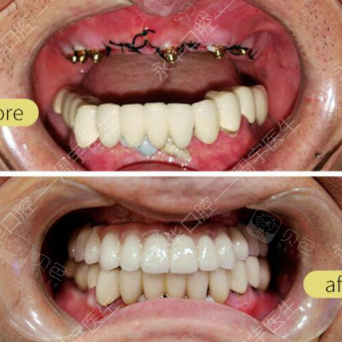 上海牙齿种植哪家医院好,分享2020上海种牙价格表!