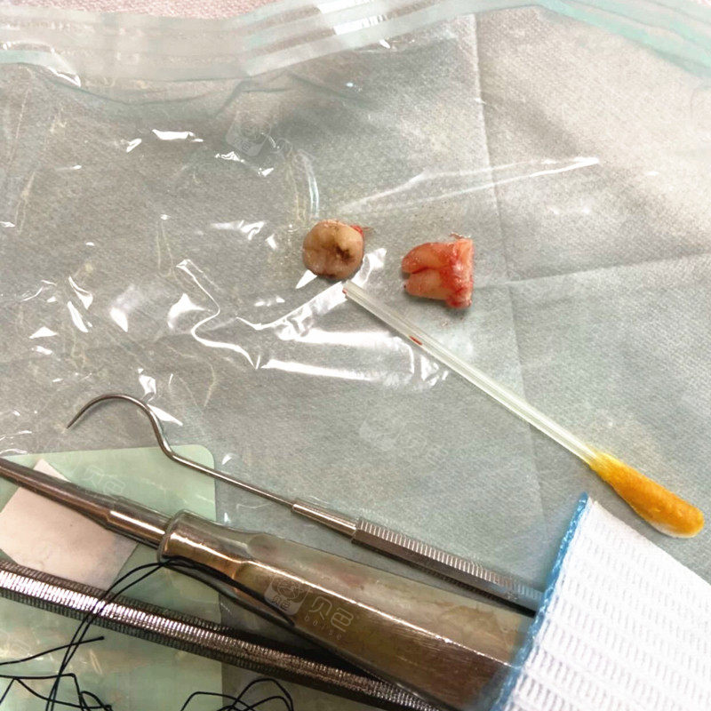 拔掉的智齿