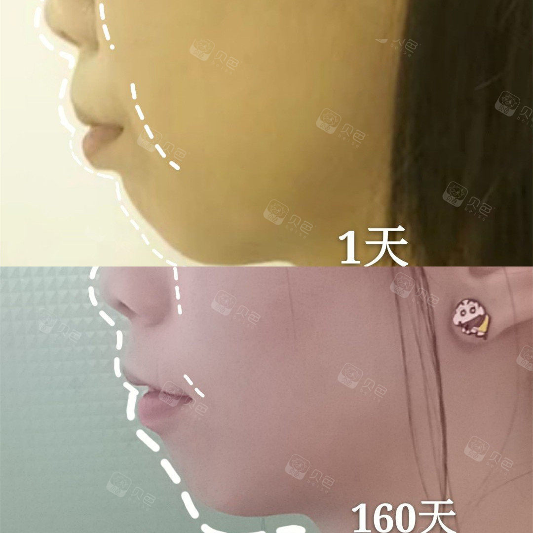 牙齿矫正前后侧面