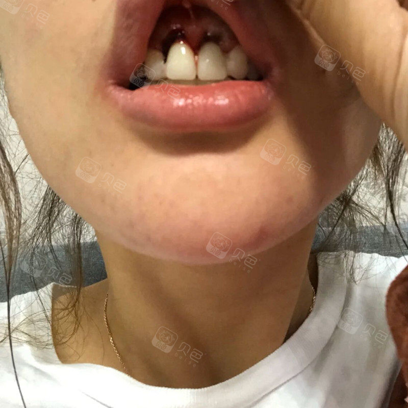 聊一聊摔跤把门牙摔断后的种牙前戴临时牙的过程