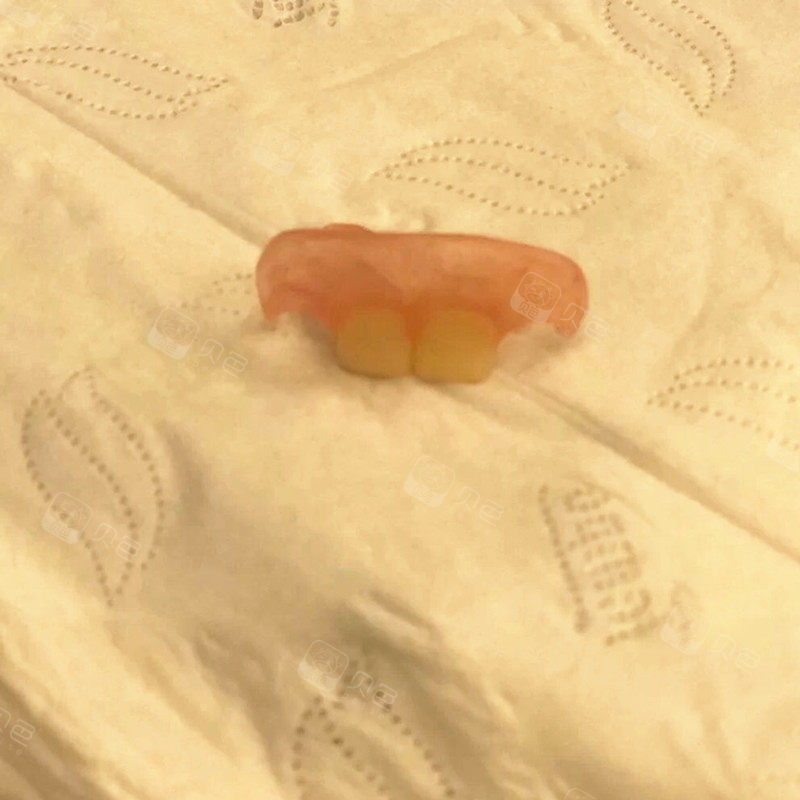 聊一聊摔跤把门牙摔断后的种牙前戴临时牙的过程