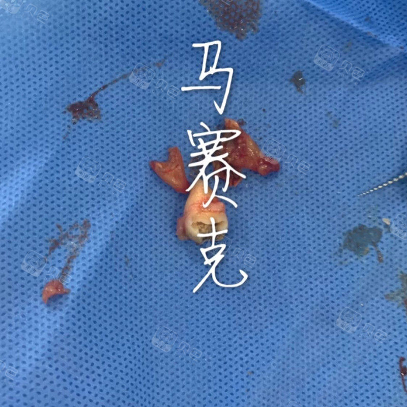 医生拔智齿却伤到我的牙神经算是我倒霉还是他技术不行