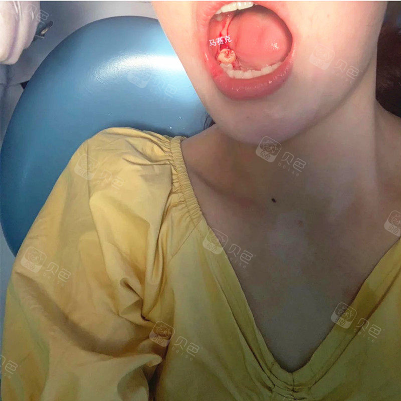 医生拔智齿却伤到我的牙神经算是我倒霉还是他技术不行