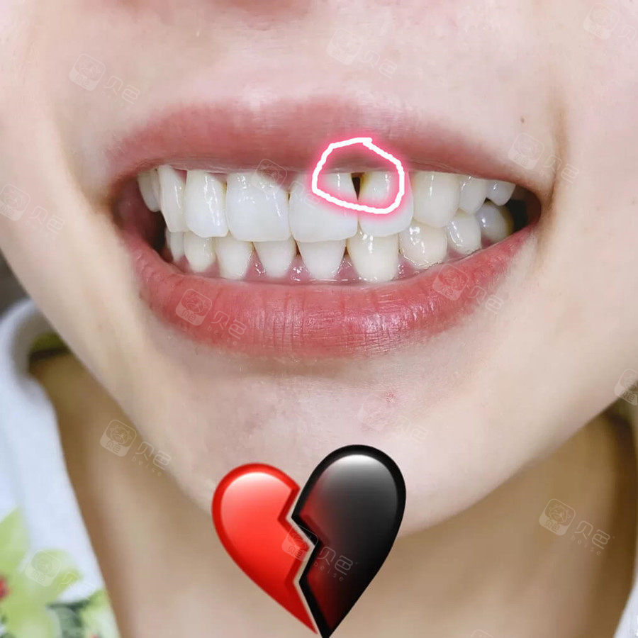 牙齿出现黑三角怎么办,我该何去何从?