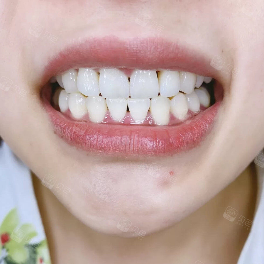 牙齿出现黑三角怎么办我该何去何从