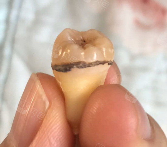 洗牙之后还是有口臭也许是因为你的龈下结石没有刮治