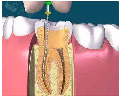 做根管治疗疼不疼亲身经历告你诉你步骤而且花不了多少钱