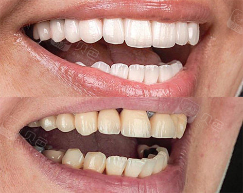 全瓷牙冠修复前后对比