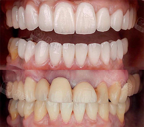 全瓷牙修复前后对比