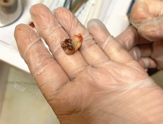 就在刚才拔掉了一颗完全龋坏的蛀牙 用时一个半小时