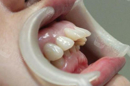 骨性龅牙不适合隐形矫正