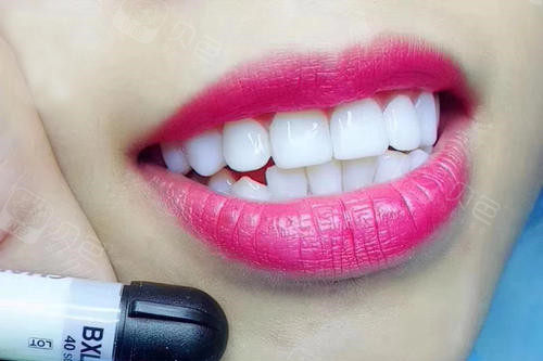 牙齿贴面多少钱一颗?美白效果好不好?