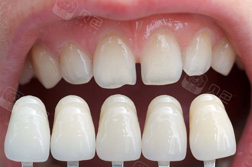 牙齿美白之牙齿贴片