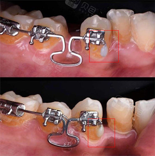 戴牙套的你有没有被钢丝扎过嘴正畸钢丝长了的原因是什么