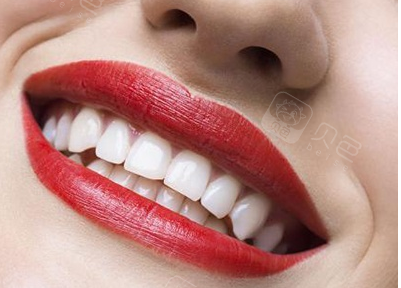 那些美白牙齿的误区,到底怎么样才能真正的美白牙齿?