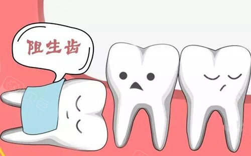 阻生智齿卡通动漫图