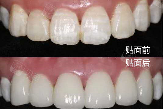 瓷贴面牙齿是氟斑牙患者的良药