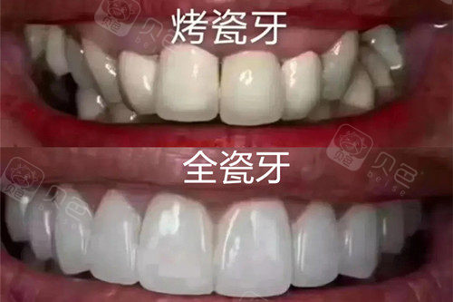 全瓷牙和烤瓷牙的效果图对比