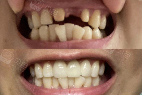 全瓷牙和烤瓷牙哪个好?价格竟然相差这么多