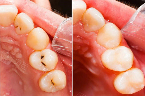 牙齿刚补完就有酸痛感,是医生没补好还是?