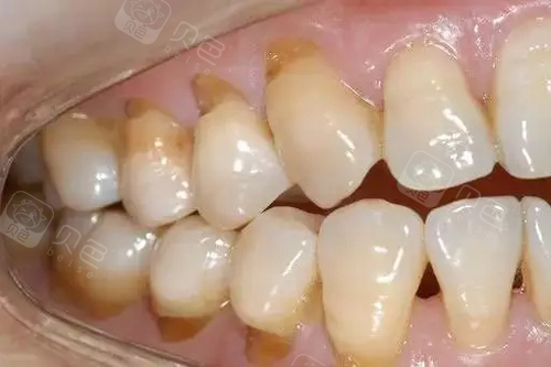 牙齿楔状缺损会断牙!怎么修复,要多少钱?