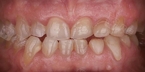 牙齿短小可以接牙吗?来看看我在杭州美奥做的效果很哇塞!