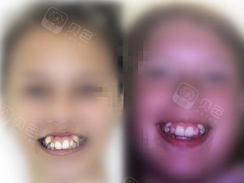 虎牙不矫正有危害吗?矫正的话需要多久!