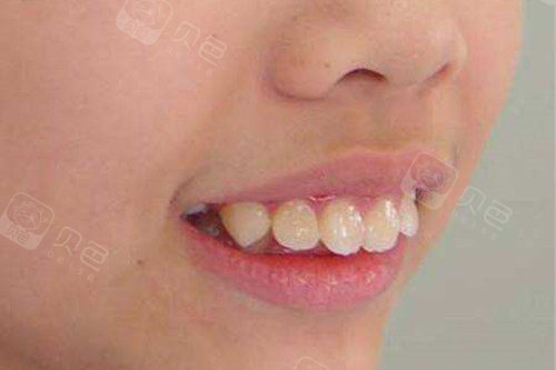 小孩子就有龅牙情况