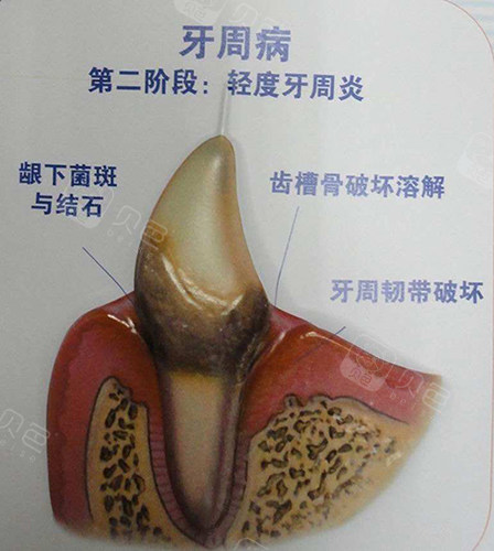牙周炎即牙周组织的疾病,具有一定的破坏性,其主要特征是牙周袋的形成