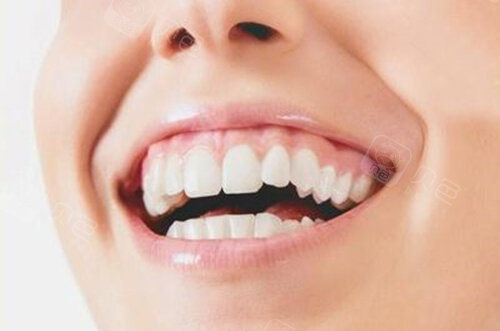 露龈笑要怎么去解决自我矫正有用吗