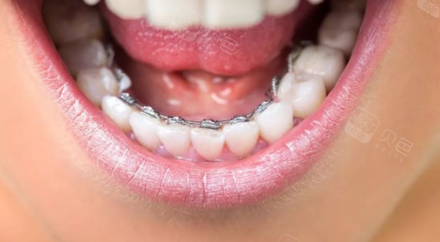 感觉舌侧矫正挺火的,为啥身边矫正的人并不多呢?