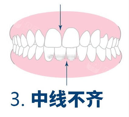 中线不齐