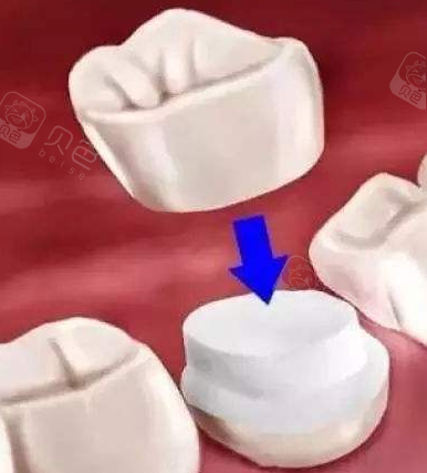 牙龈上长了个脓包,竟然要做根管治疗?