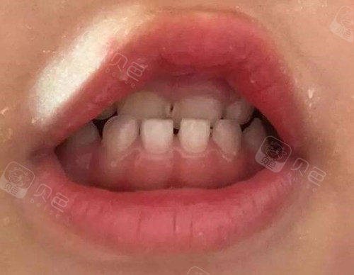 如果孩子7岁前后牙齿有这些情况的建议及时就诊