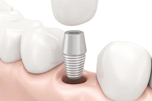 无锡佳士洁口腔采用德国精工标准的数字化种植系统,引进德国西诺德