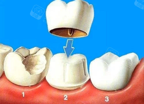 根管治疗要几次才能完成?做完当天可以刷牙吗?