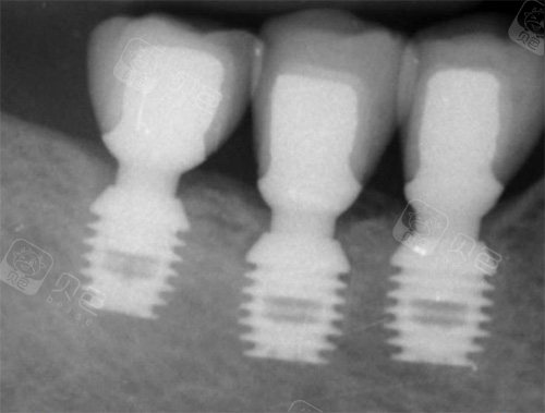 百康短种植体植入后影像图