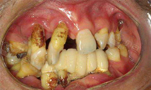 全国爱牙日怎么保护好自己的牙齿?窝沟封闭预防龋齿!