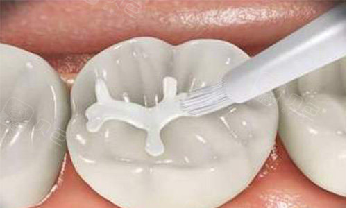 全国爱牙日怎么保护好自己的牙齿?窝沟封闭预防龋齿!