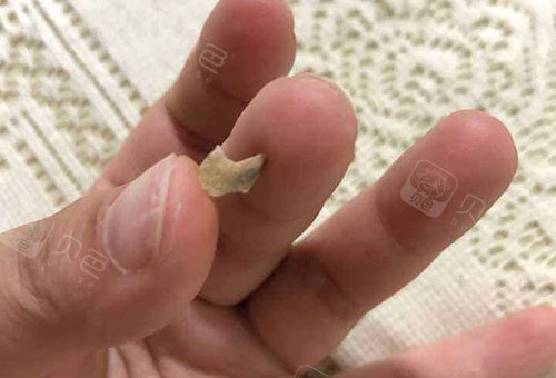 我的牙结石自己掉了怎么办?宁波洗牙高性价比好医院附价格