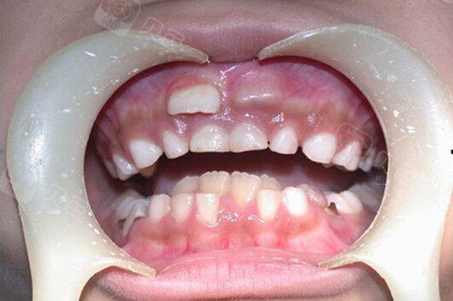 家长朋友注意了:孩子长双排牙可能是你的过错