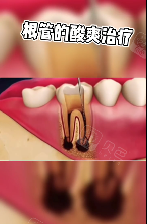根管治疗抽神经