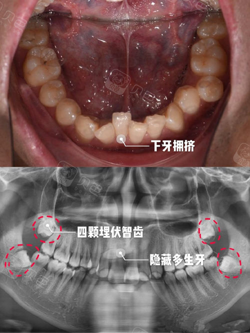 小孩拍牙片有辐射吗?
