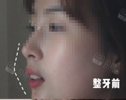 花了2万2做了陶瓷矫正牙齿 效果不要太好了 贝色口腔