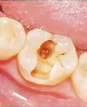去做了3m树脂补牙想知道补过的牙齿能用多久