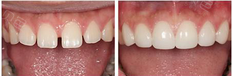 亲身经历揭秘,门牙有缝儿是贴面好还是牙齿矫正好!