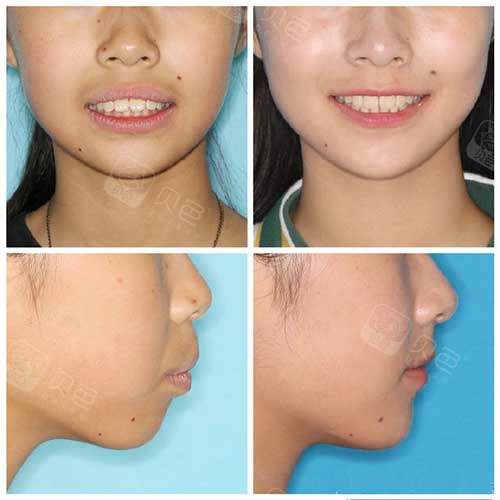 青少年牙齿矫正对比照片