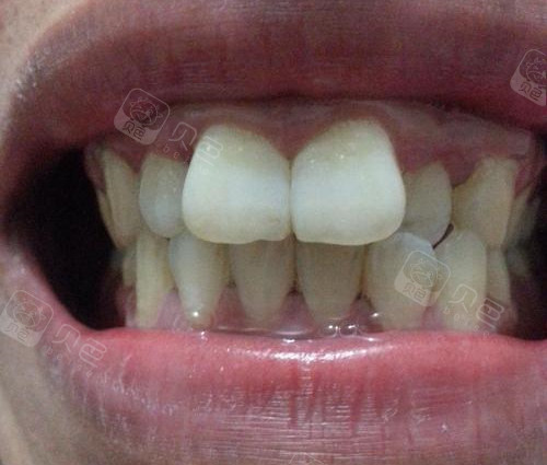 门牙外凸想做牙齿矫正,广州这家医院9000元就能做!