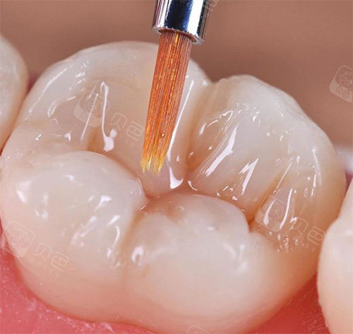 补完的牙齿状态